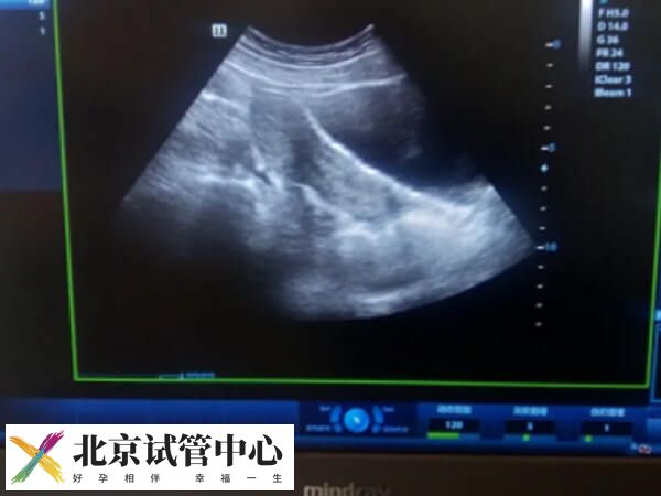 哪些情况下会取消鲜胚移植(图1)