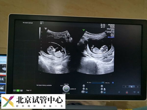 移植两个胚胎是不是双胞胎(图1)
