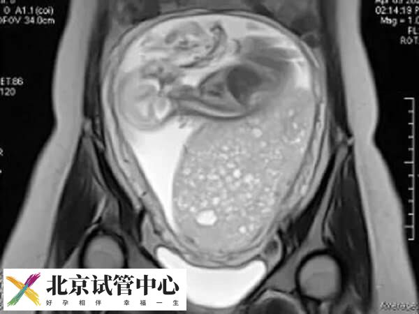 试管出现葡萄胎是什么原因(图1)